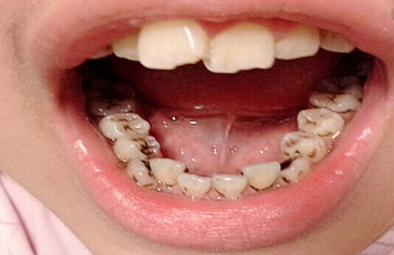 牙齿上的小黑点是怎么回事?洗牙能把它们去除吗?