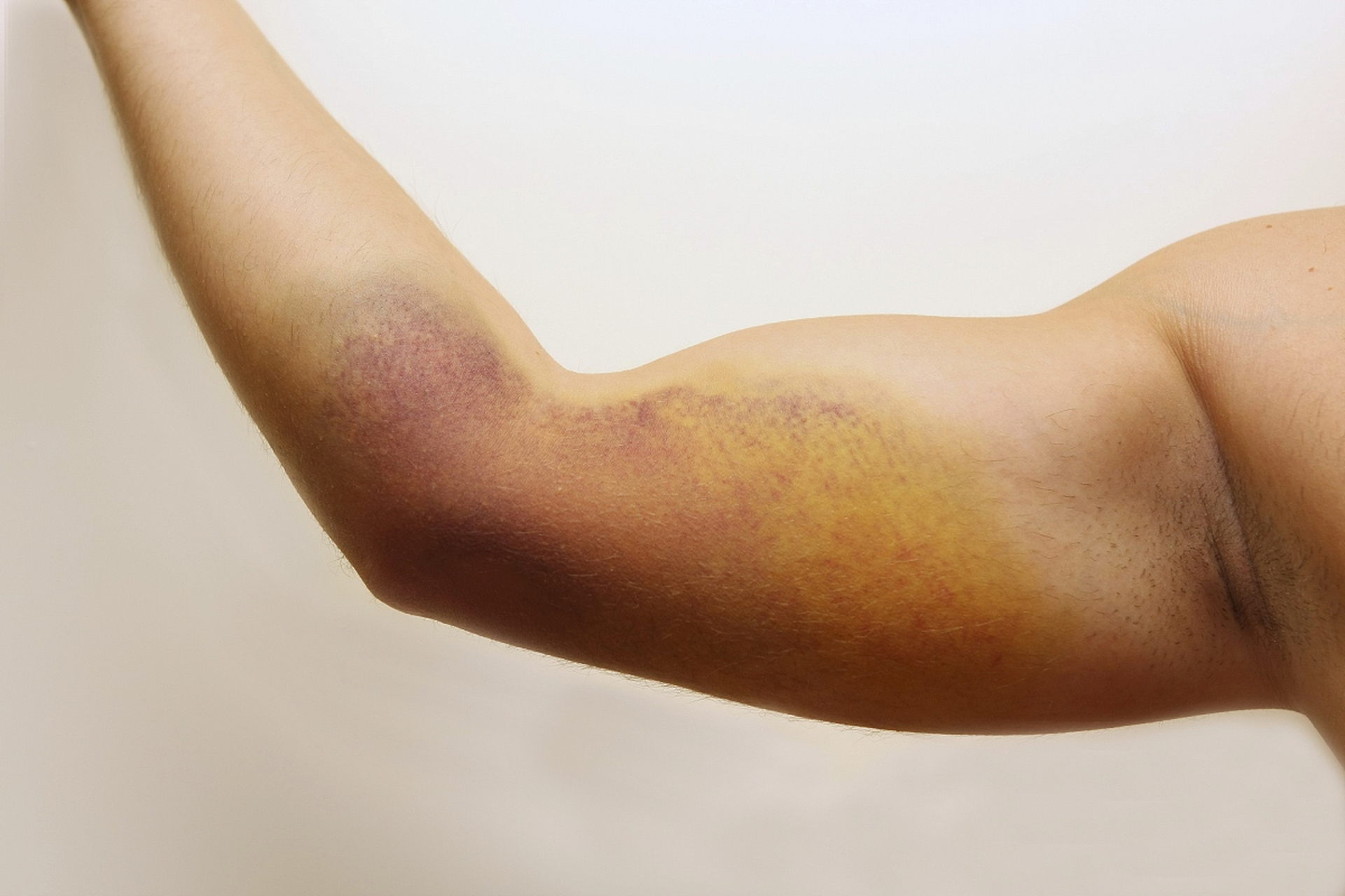 乳腺癌患者术后如何预防手臂肿胀?