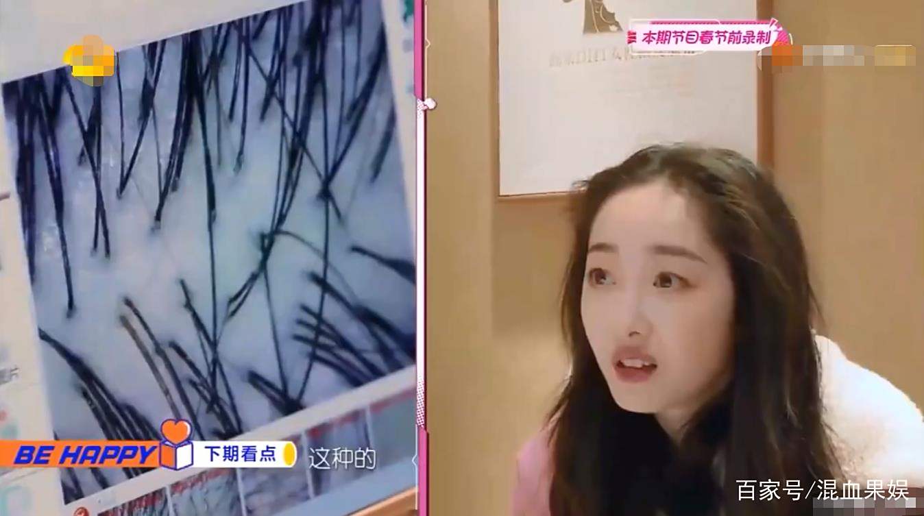 蒋梦婕因发际线高跑去植发却被医生的话吓到:要先从后枕部取出来 蒋梦婕因发际线高跑去植发却被医生的话吓到:要先从后枕部取出来