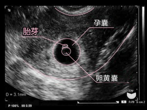 孕2月胎芽发育快报 b超单上能看见这四物