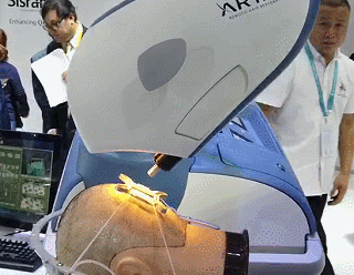 这届进博会亮相的植发手术辅助机器人 也许可以帮到你 取发系统能在