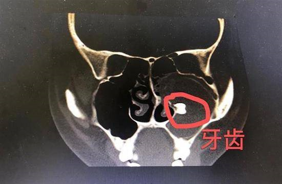 多生牙在鼻子里图片图片