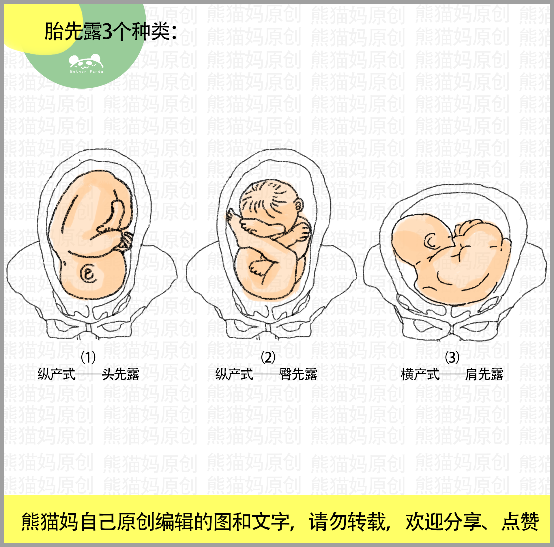 头先露的4个种类: (1)枕先露 (2)前卤先露 (3)额先露 (4)面先露