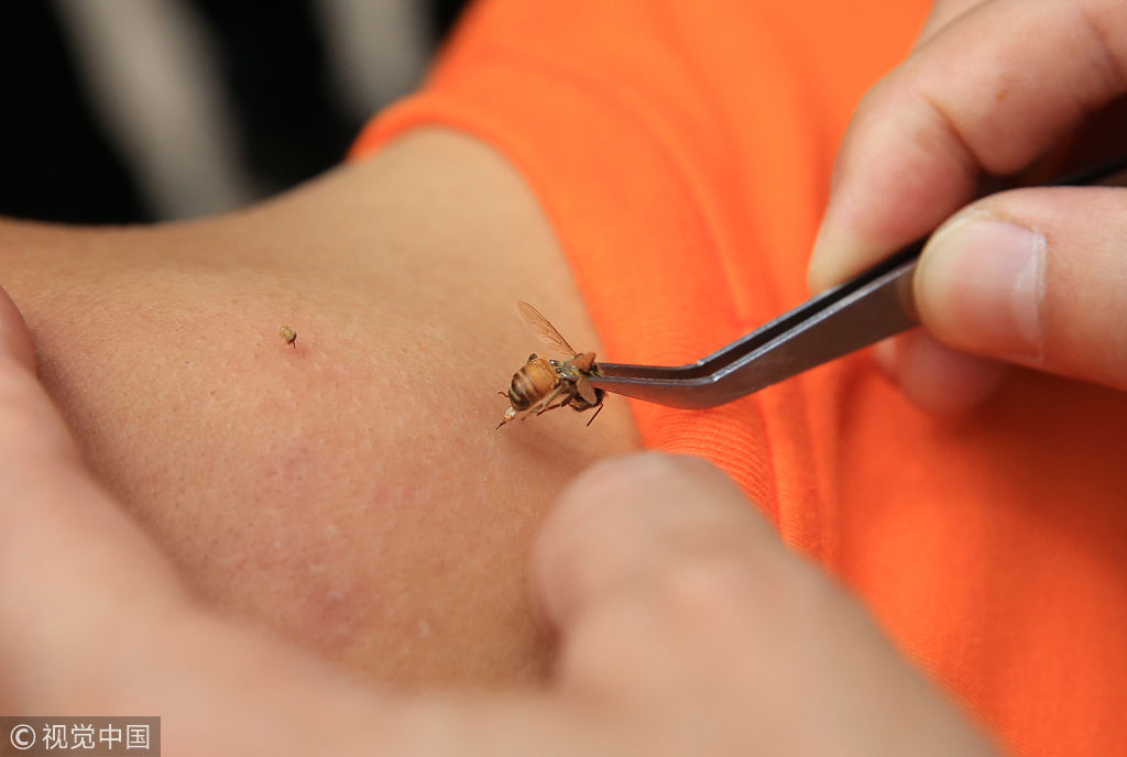 被蜜蜂蜇可以治病?非专业人士切勿轻易尝试