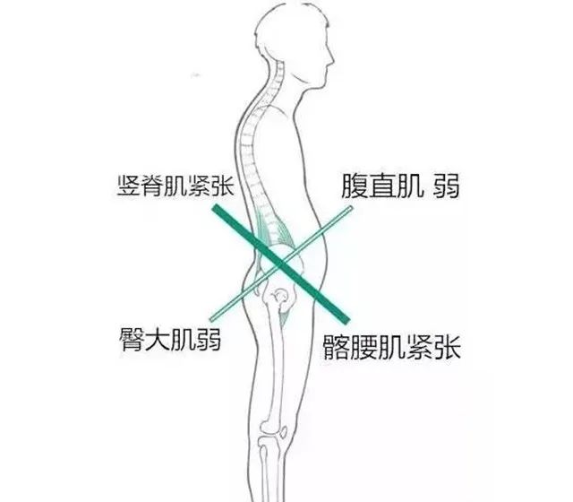 天生翘臀?请警惕下交叉综合症