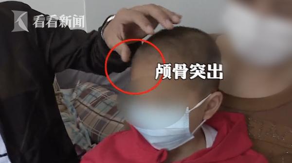 湖南现大头娃娃,只因其把蛋白饮料当奶粉喝,有些常识妈妈应知道