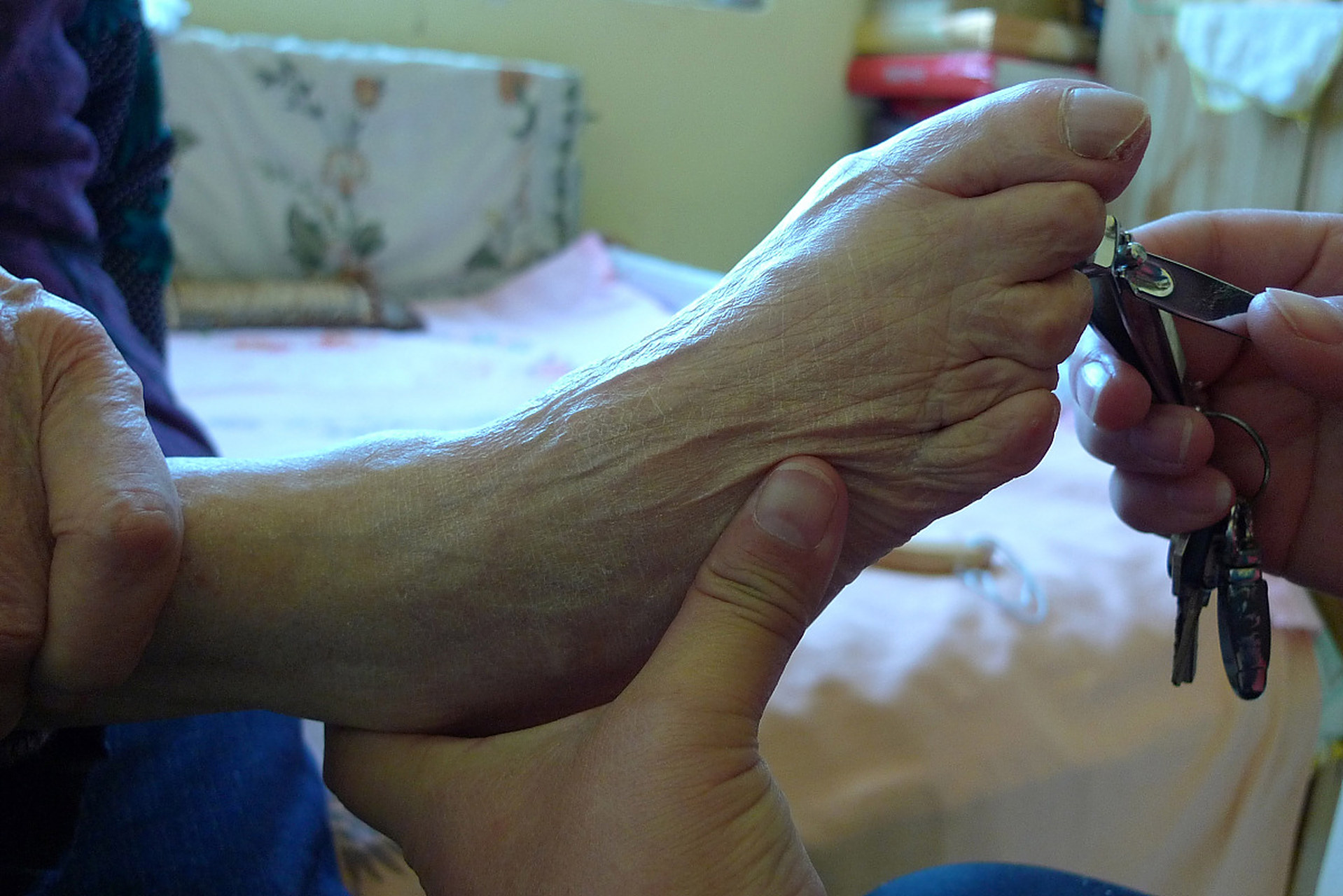 拇外翻手术一般用时多久呢?要住院吗?多久能工作呢?