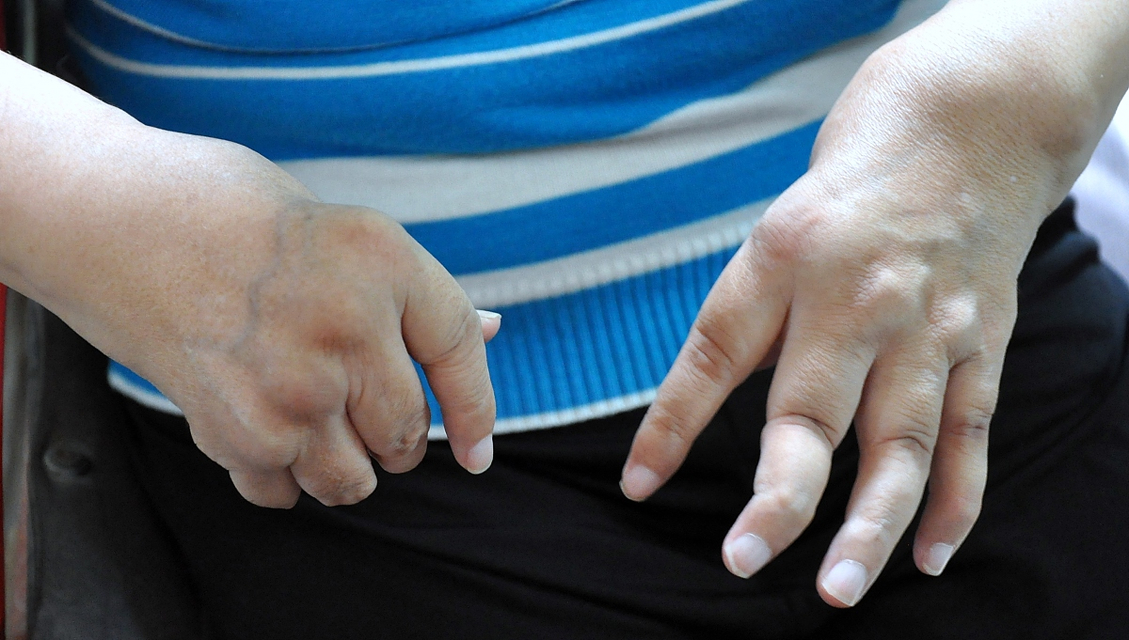 患上腱鞘炎,有何常见症状?