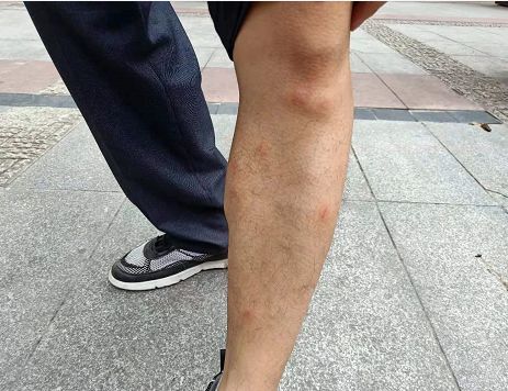 一家三口贵阳住酒店,第二天,丈夫两条腿竟肿成了这样!