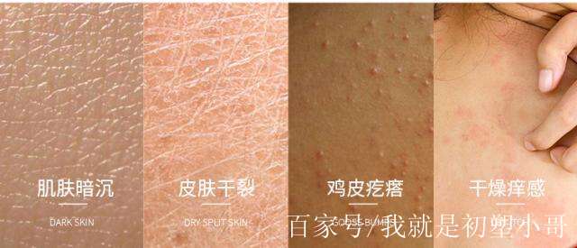 腿部鸡皮疙瘩怎么办社保卡(腿子上面全是鸡皮疙瘩怎么办) 腿部鸡皮疙瘩怎么办社保卡(腿子上面全是鸡皮疙瘩怎么办)