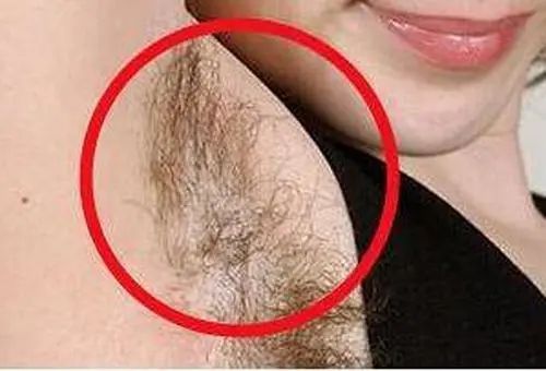 可能是腋毛癣,得治!