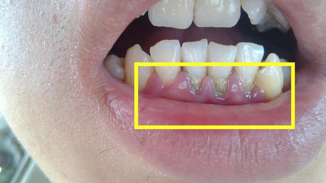 牙龈牙缝出现"黑斑,黑块",是牙龈癌的征兆?医生表示长点心吧