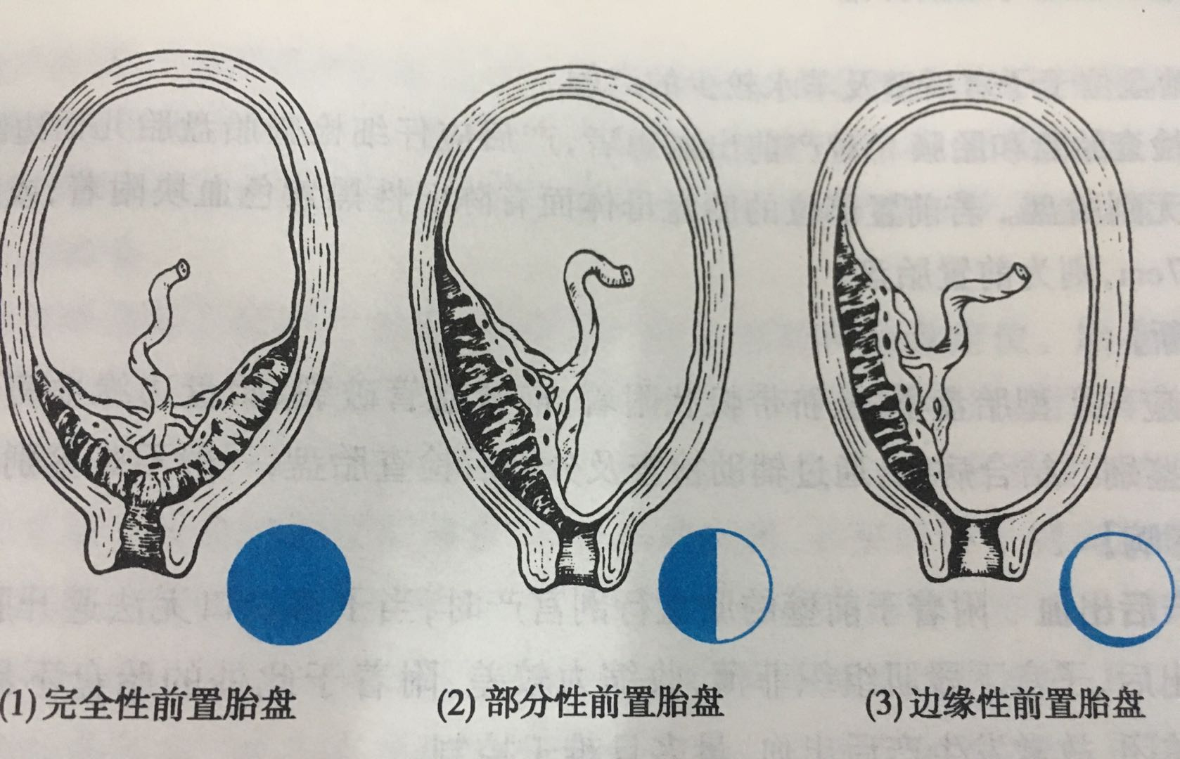 胎盘位置低出血,需要引产吗?