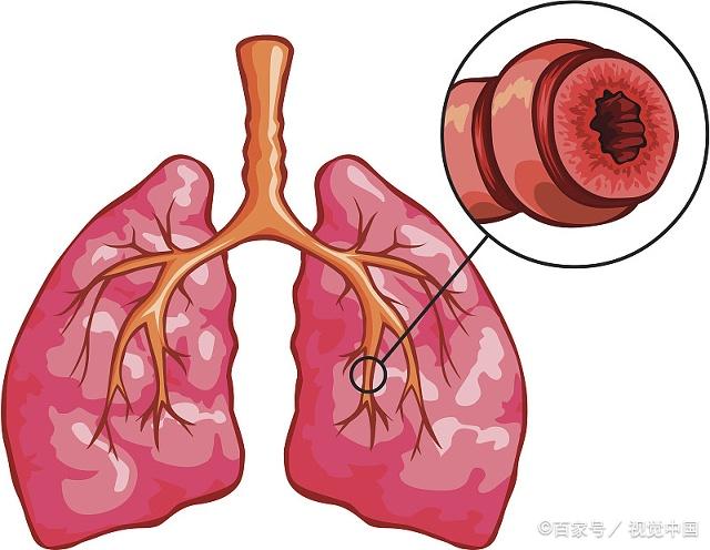 支气管炎9大症状,坚持做好这3件小事,早看早好!