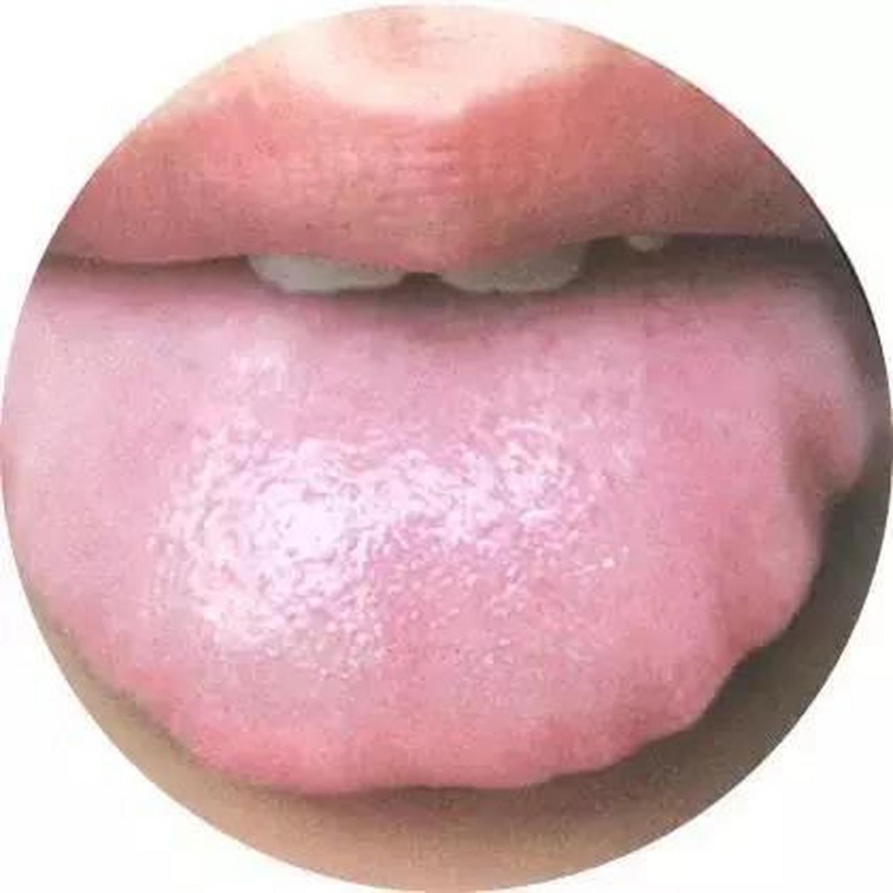 【艾灸舌诊之舌有齿痕】 舌边有齿痕,舌体偏白,舌苔偏白,说明脾肾阳虚