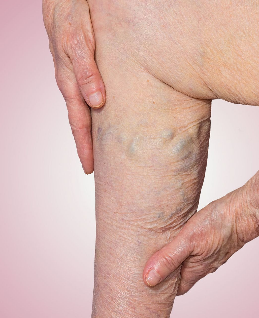 静脉曲张会不会危及生命,为什么都建议早期治疗呢?