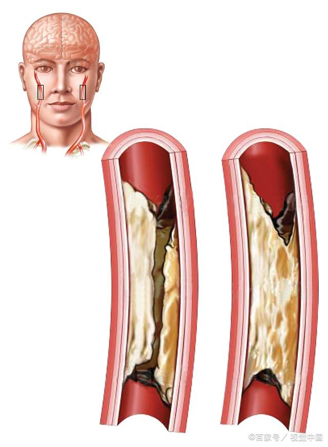 脑动脉硬化其实是有信号的!快看看有没有你