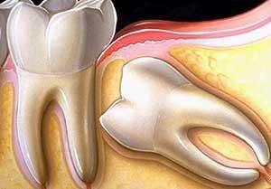疑问:智齿不疼不痒正常生长,还需要拔吗?