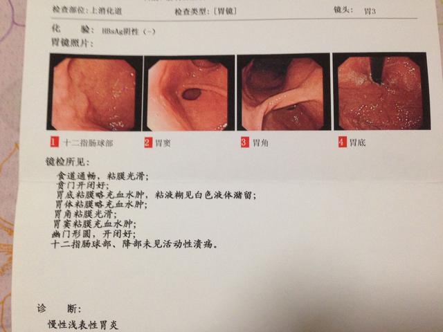 反反复复的上腹疼痛7年,对付老胃病是因为药不好吗?