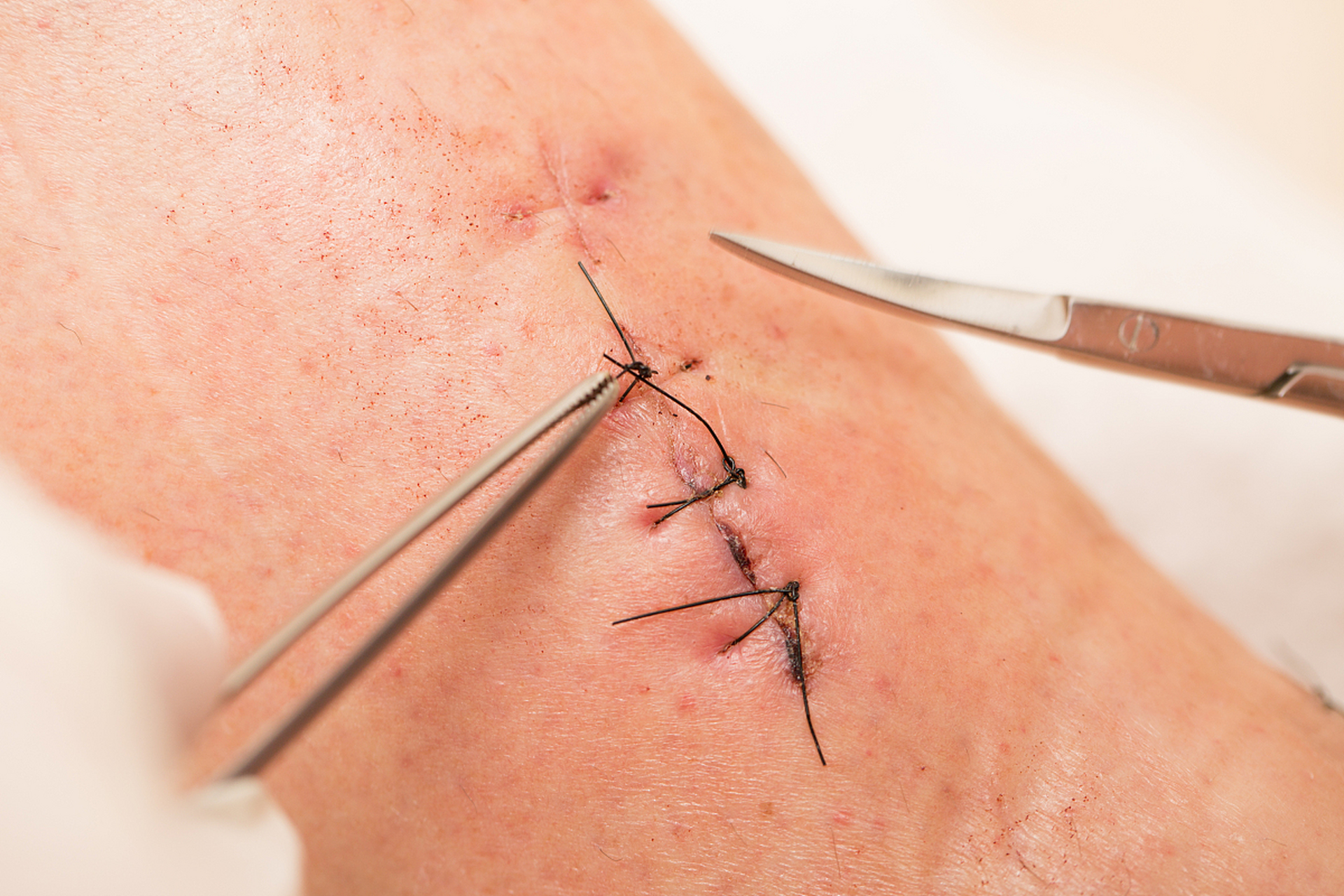 医生会根据患者的手术方式,伤口的愈合情况等因素,精准地判断拆线的