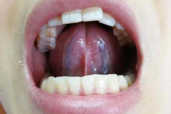 舌下血管四级瘀堵图片