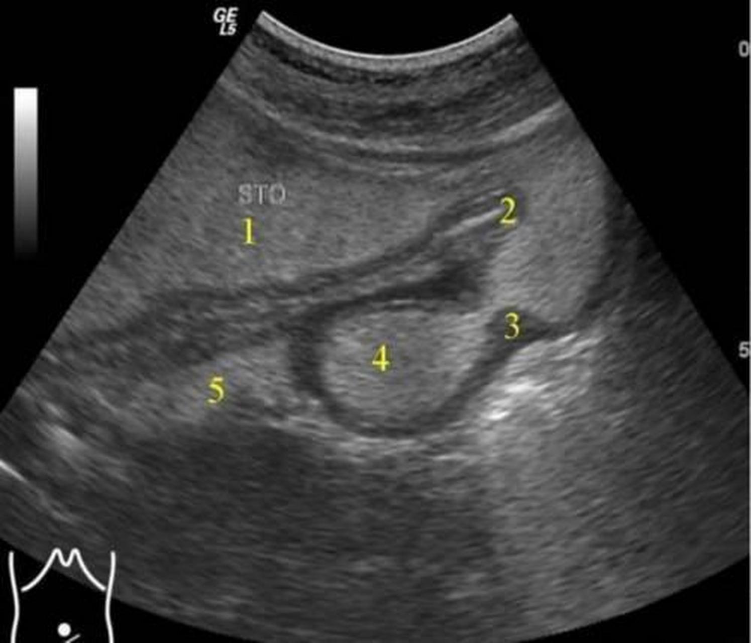 科普知识竞赛#胃肠型和蠕动波检查是指通过检查胃肠型产生的蠕动波来 