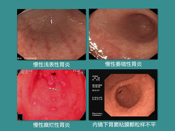 患了胃炎,还感染了幽门螺杆菌,教你一招,能够阻断癌变!