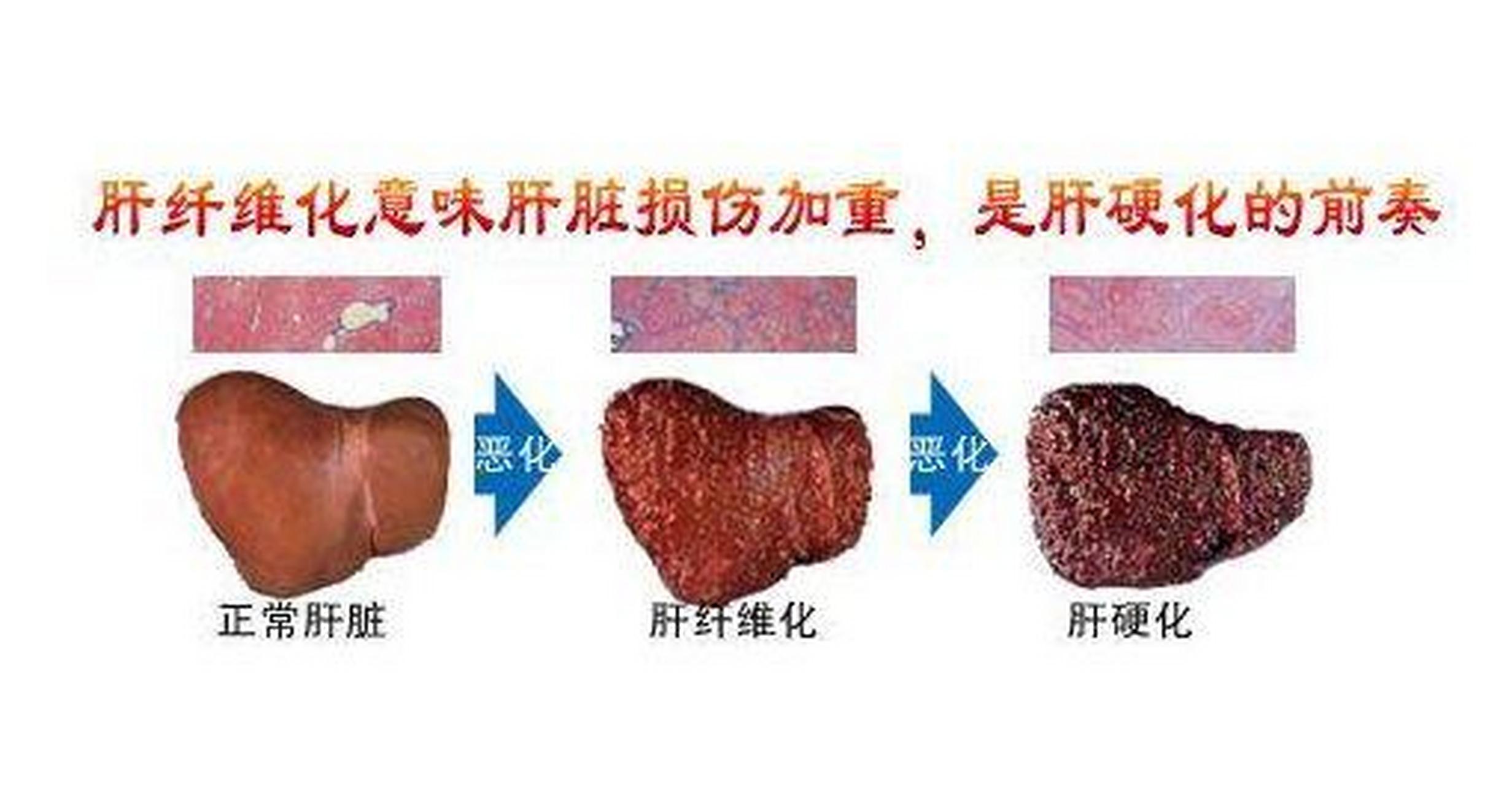 科普知识竞赛#肝纤四项即肝纤维化四项检查,即有pcⅢ(iii型前胶原)