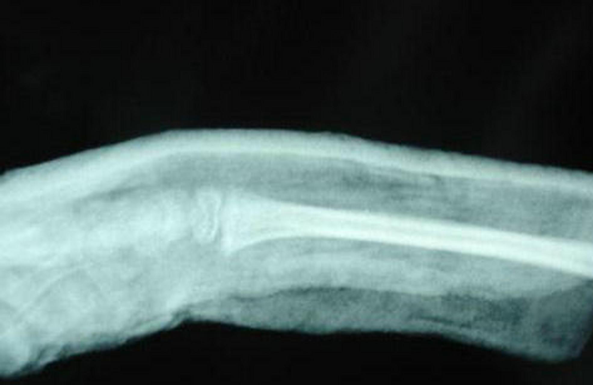 #科普知识竞赛#餐叉畸形即colles骨折,即桡骨下端骨折的一种典型畸形.