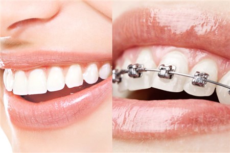 矫正门牙突出的方法 这些方法你要了解