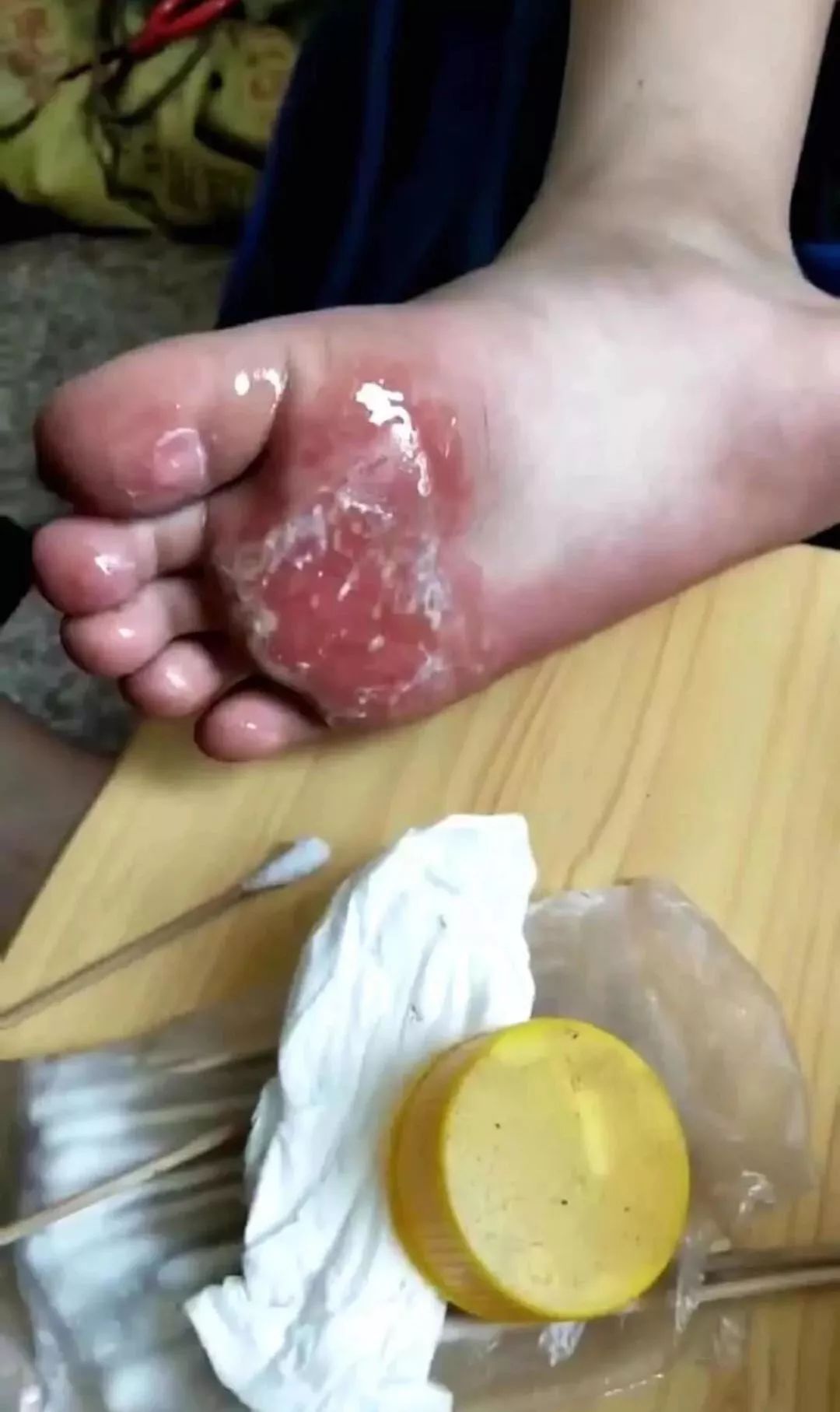 网友爆料:霞浦小学生32℃高温下被罚光脚上课遭烫伤!