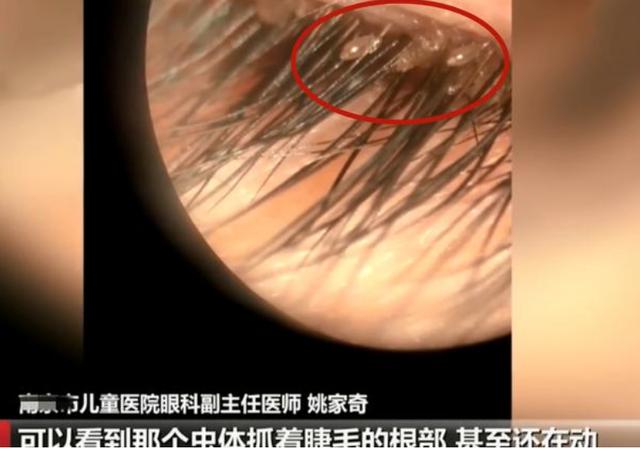 女孩说眼睛痒,到医院检查竟发现20多条虱子,医生提醒:注意卫生