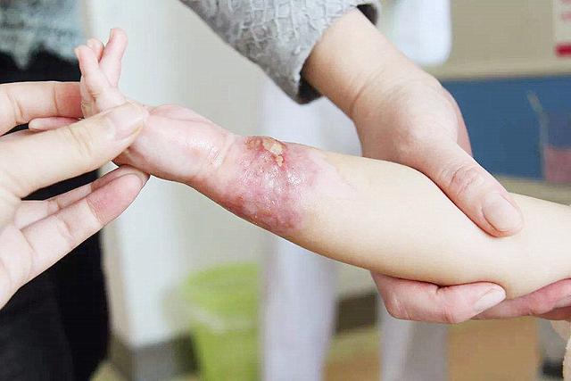 孩子被开水烫伤,冲水脱衣哪个先,顺序搞错,只会加重伤情