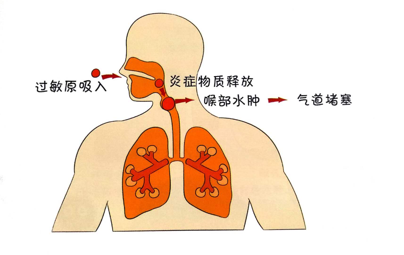 怎么判断喉头水肿图片