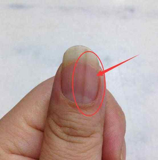 大拇指甲竖纹肝癌图片图片