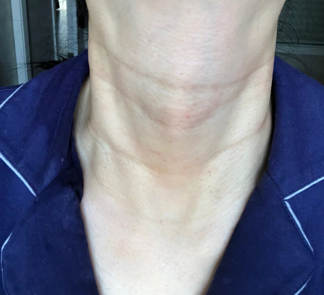 颈纹深显老又掉气质,夏天穿裙子都不能美美的,这样护理会好很多