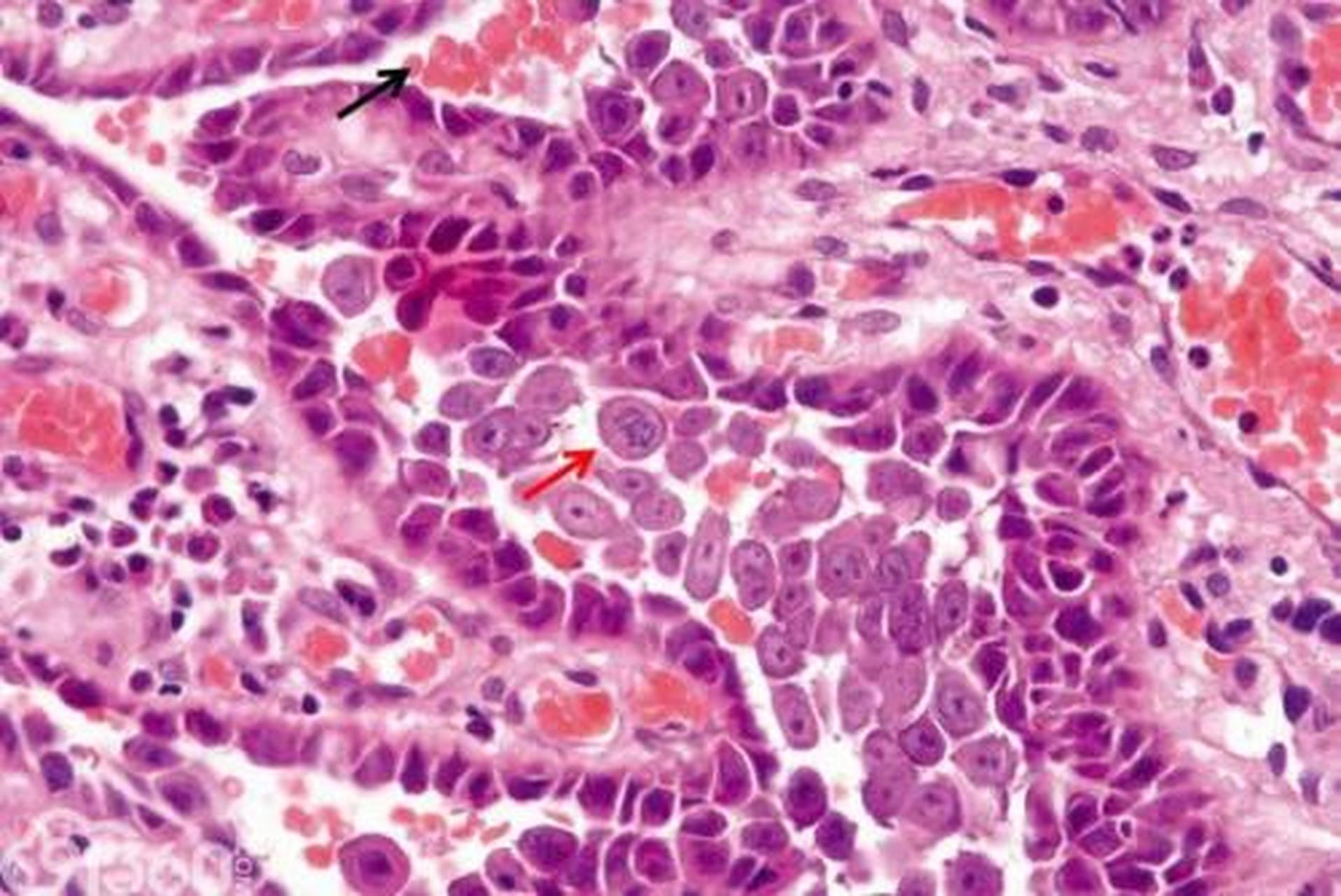 科普知识竞赛#棘层细胞松解征检查是皮肤科常用的体格检查方法之一