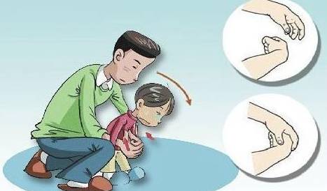 男童被花生呛住窒息死亡:海姆立克急救法,关键时刻救命法