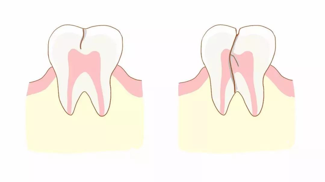 什麼是牙隱裂?牙隱裂圖片?