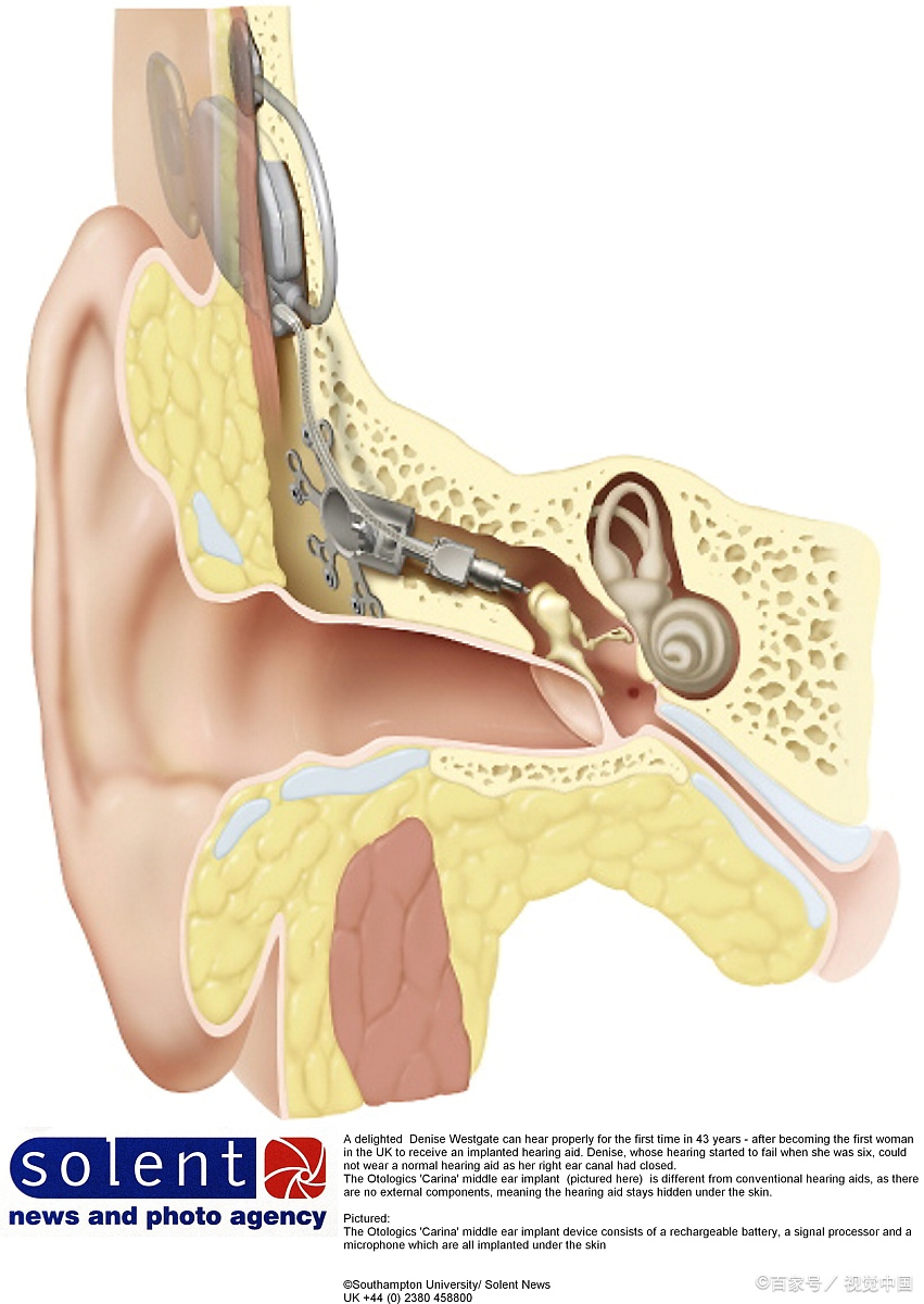 人工耳蜗和助听器区别图片