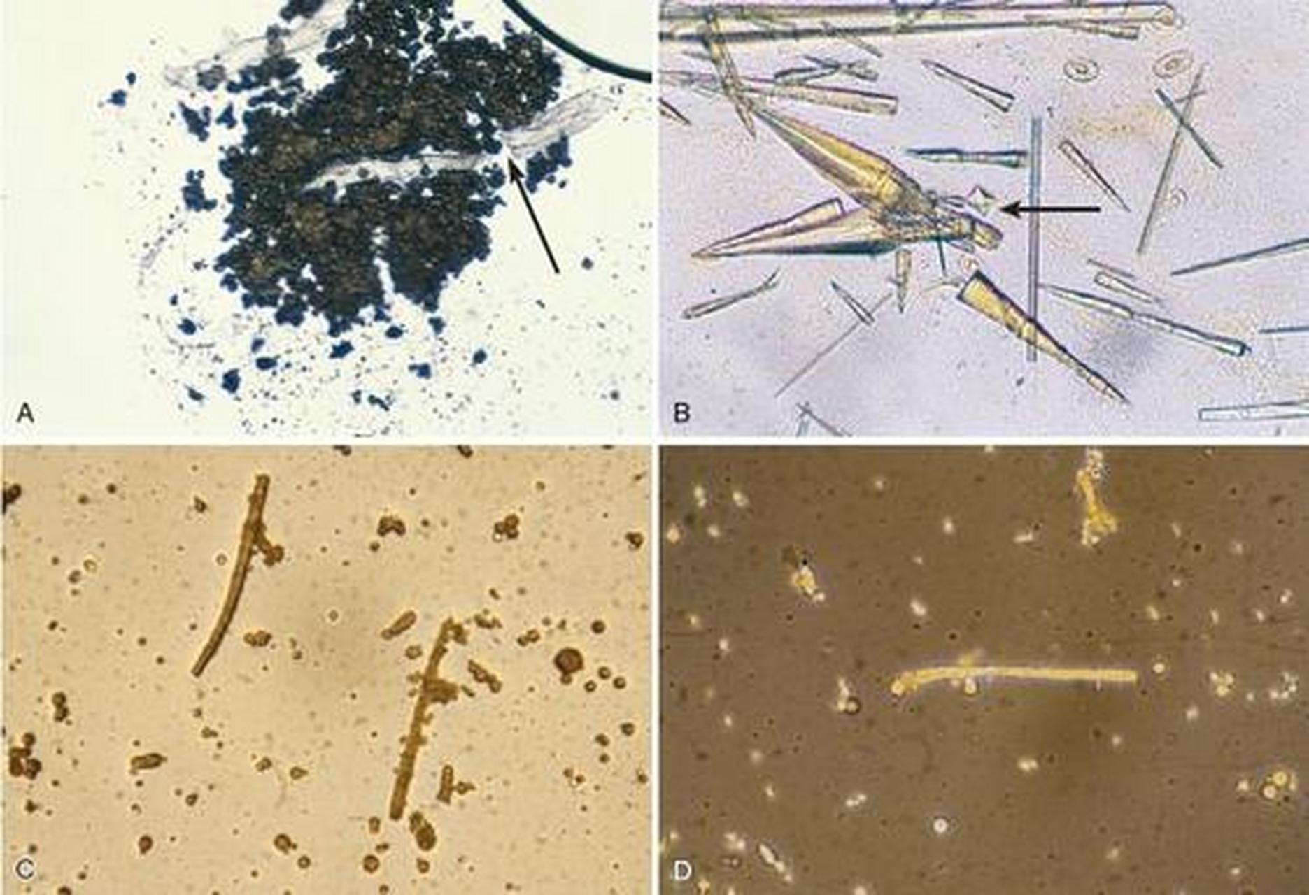 科普知识竞赛#尿结晶检查是尿沉渣检查的内容之一.
