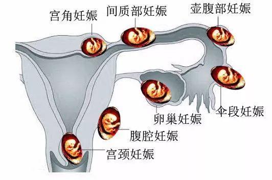 妊娠就是怀孕吗 baijiahao.baidu.com