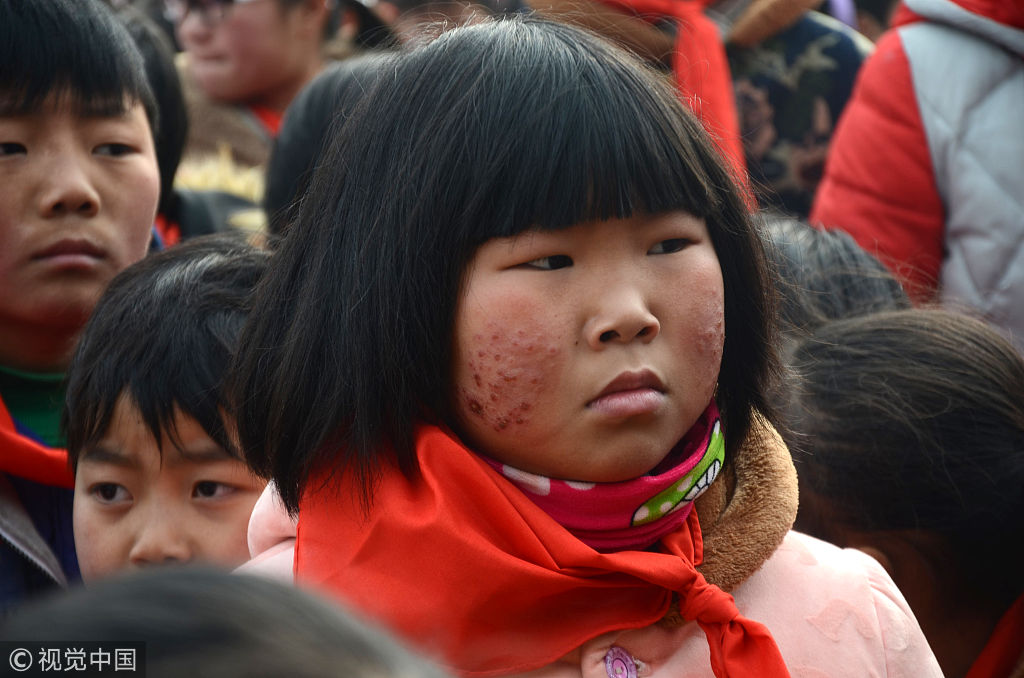 小孩脸上冻疮图片