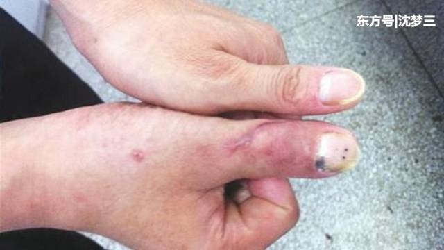 一女子手指被机器绞断,脚趾移植到手指,看着还不错!