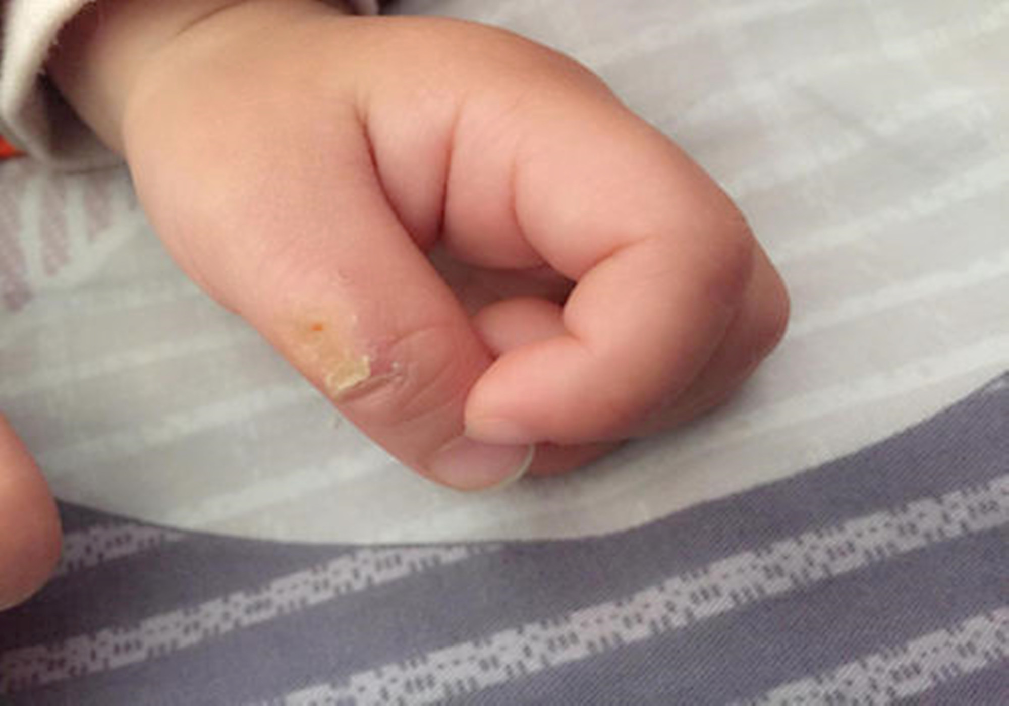幼儿吃手指细菌图片图片