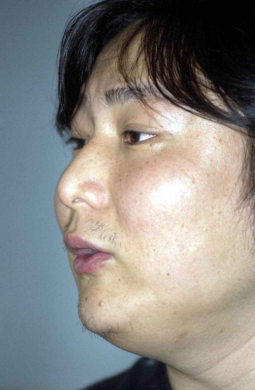 怎么去除下巴赘肉  想要去除下巴赘肉,首先要了解下巴赘肉形成的原因.