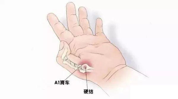 孩子拇指不能伸直,可能是因为得了扳机指