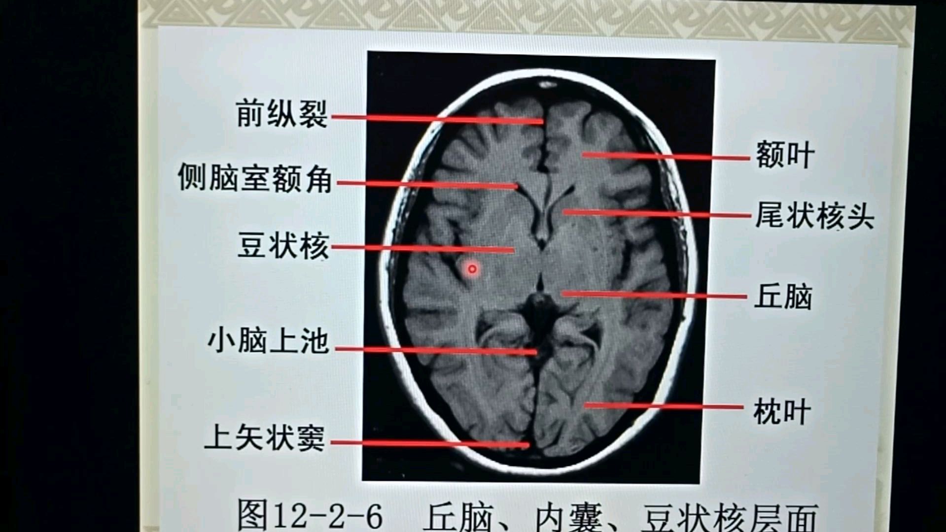 [图]基底节包含哪些结构?在影像上如何区分?