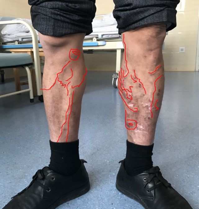 身体这4个部位有青筋凸起,那意味着身体出现了问题,抓紧看看!