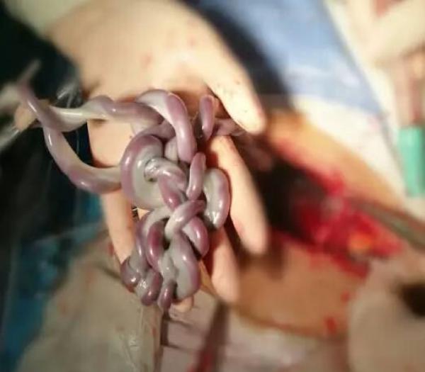 28岁孕妇怀胎七月被迫提前剖腹产,医生划开肚皮吓得两腿发软